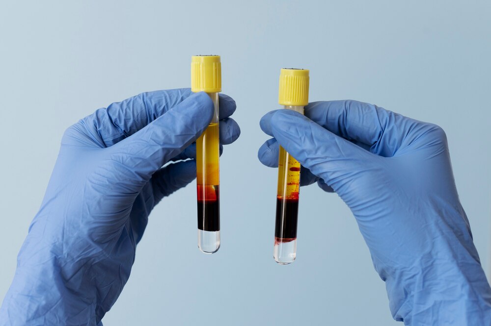 Hands with gloves holding vials for prp